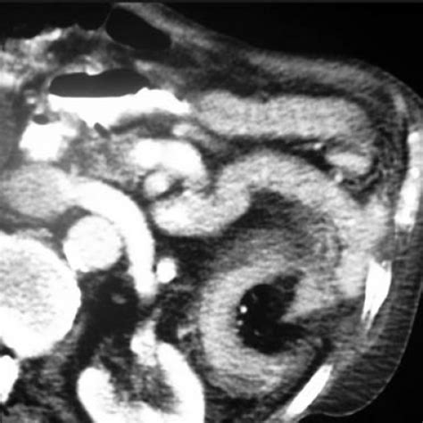 Intussusception symptoms and signs in infants include currant jelly stool, abdominal pain, and vomiting. Adult small bowel intussusception | Eurorad