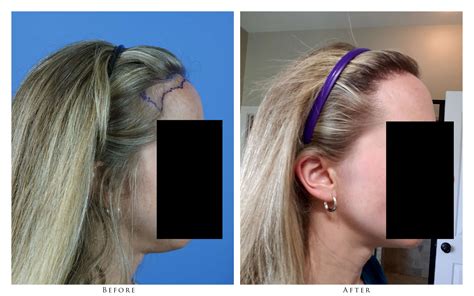 Yr Old Woman Has Graft Hair Transplant With Dr Gabel Before And After Photos Gallery Oregon