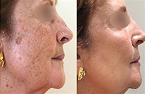 Age Spots Treatment The Angel Laser Clinic
