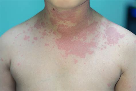 Skin Rashes In Children Causes And Treatment