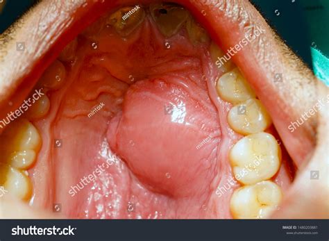 Abscess On Palate Anterior Tooth Infection Stock Photo 1480203881