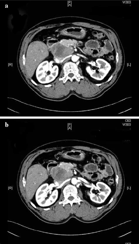 Imaging Studies Of A Patient With Aortocaval Lymph Node Recurrence With