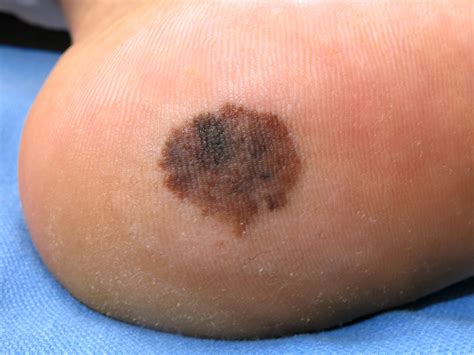 Early Detection Of Melanoma And Assessment Of Asymptomatic People At