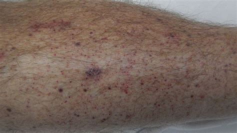 Petechiae Causes Treatments Pictures And More