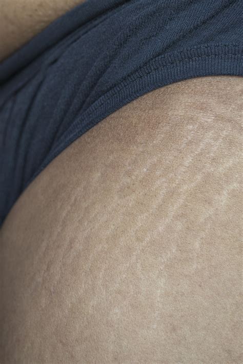 Stretch Marks Treatment How To Minimise Stretch Marks If You Want To