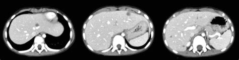 Ct Scan After Intravenous Injection Of Iodine Contrast Media Acquired