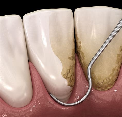 Periodontal Therapy Houston Tx Gum Disease Oral Health