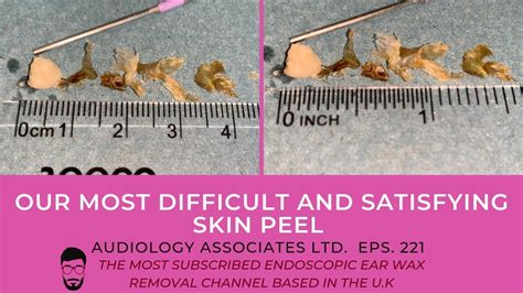 Our Most Difficult And Satisfying Skin Peel Ep 221 Youtube