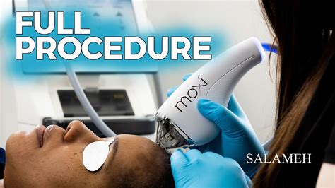 Sciton Moxi Laser Treatment Full Procedure Salameh Oasis Medical