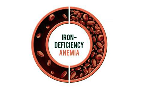 Management Of Iron Deficiency Anemia In Adults Bsg Guidelines