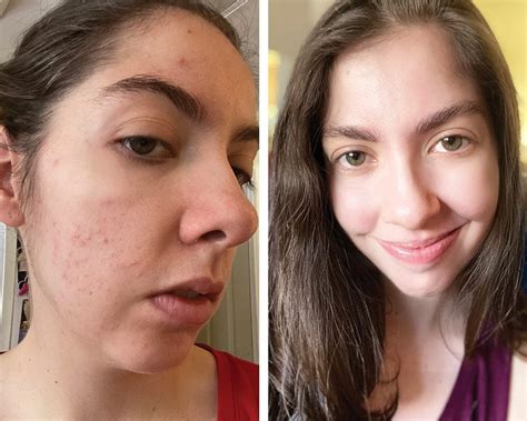 Accutane Before And After How I Survived Taking It For Acne The Healthy