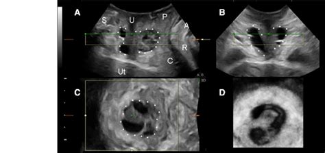 Urethral Diverticulum Ultrasound