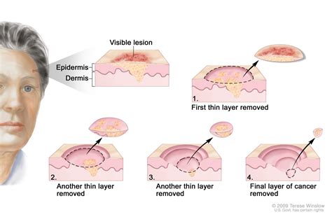 Treating Squamous Cell Skin Cancer Treatment Options Skin Cancer Education And Research