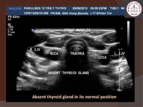 Ultrafeast Lingual Thyroid