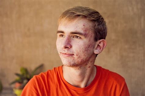 Close Up Of Young Attractive Man With Problematic Skin And Scars From