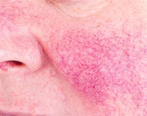 Rosacea Treatments Visible Blood Vessels Removal