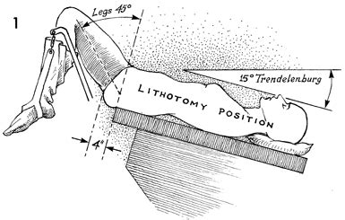 Laparoscopy Technique