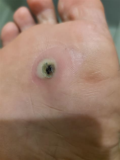 Should I Cover My Plantar Wart Being Treated With Liquid Nitrogen