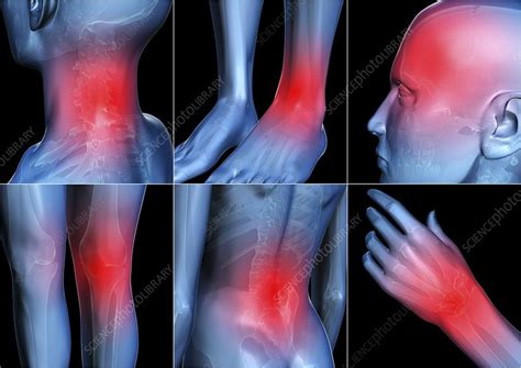 Body Pain Artwork Stock Image C0018540 Science Photo Library