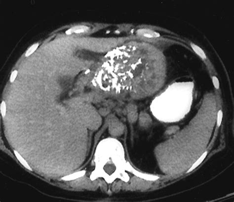 Ct Features Of Castleman Disease Of The Abdomen And Pelvis Ajr
