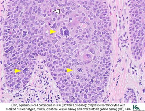 Pathology Outlines Squamous Cell Carcinoma In Situ Bowen Disease