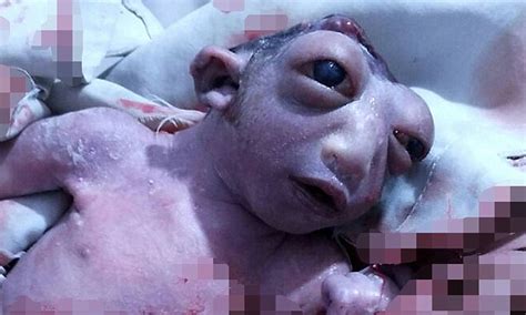 Baby Girl Born In India With Only Half A Head And Gigantic Eyes Daily