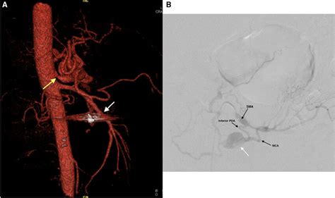 A Three Dimensional Ct Recon Saggital View Showing Coeliac Axis