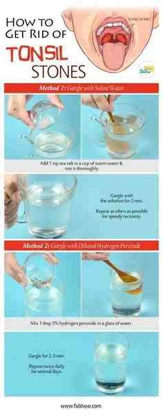 Home Remedies For Preventing Sore Throat Tonsils Stop Does Getting