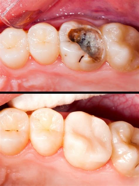 Cavity Before And After