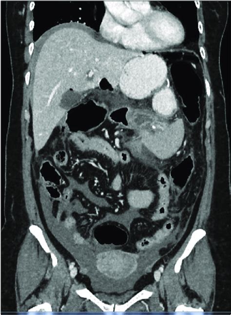 Case 1 Coronal View Of The Cect Of The Abdomen And Pelvis Lesser Sac