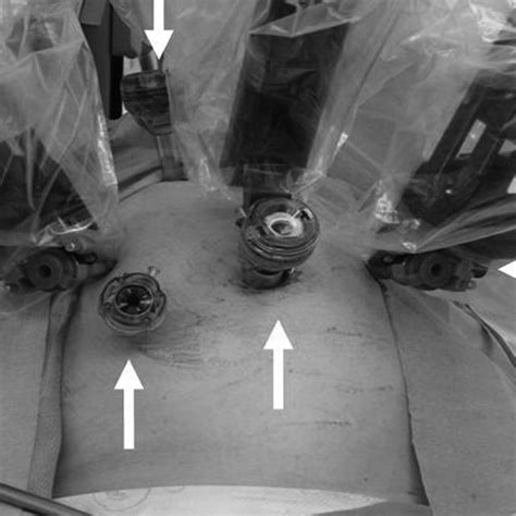 Trocar Placement For Robotic Radical Hysterectomy And Bilateral Pelvic Download Scientific
