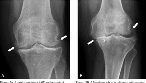 Figure 2 From Knee Osteoarthritis A Primer Semantic Scholar