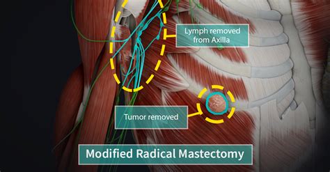 Types Of Mastectomy Complete Anatomy
