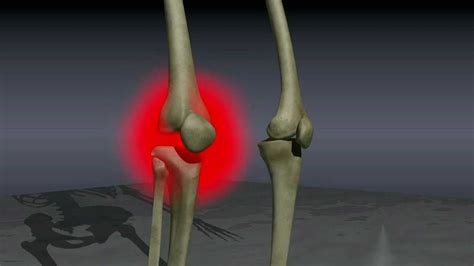 Knee Osteoarthritis Youtube