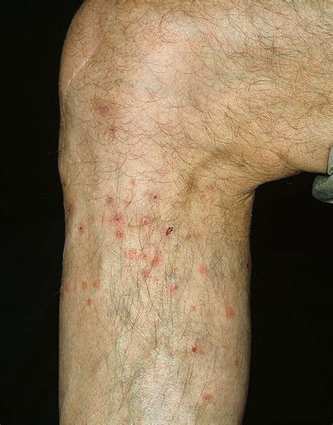 Flea Bites On Humans Pictures Symptoms And Treatment