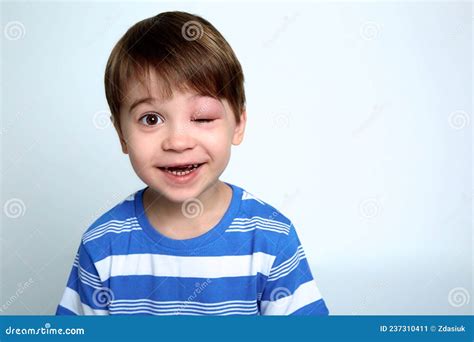 A Boy With Swollen Eye From Insect Bite Quincke Edema Close Up Stock