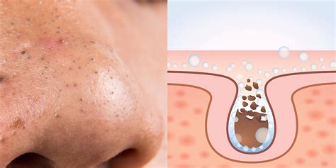 It is often beyond the repair of soaps and face washes, and in some cases. How To Remove Blackheads On Nose Naturally | WebeMax