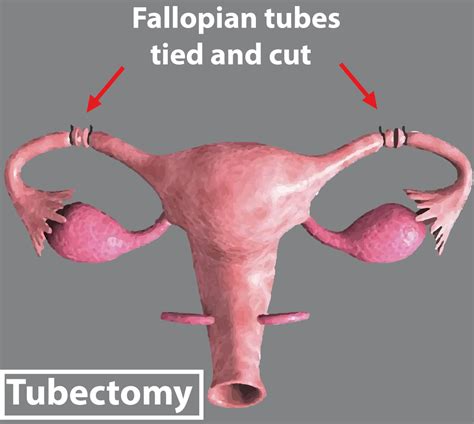 After Tubectomy Which Part Of The Female Reproductive System Remains