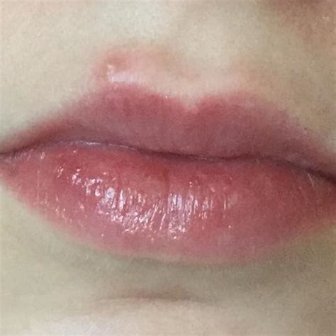 Habe seit einigen tagen einen pickel in der innenseite meiner oberen lippe. Herpes oder doch ein Pickel? Hilfeee (Lippe, wegbekommen)
