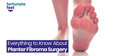 Everything To Know About Plantar Fibroma Surgery Fortunate Feet