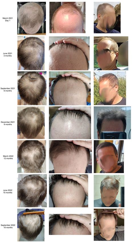 Years Of Medication Progress And The Road To A Hair Transplant R