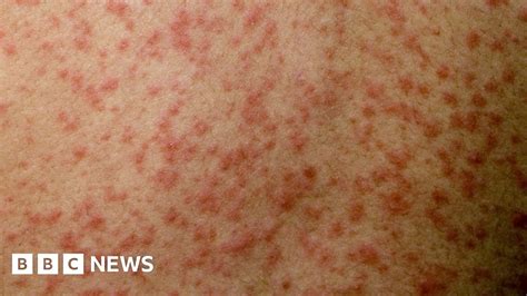 Measles Outbreak Feared In London And South East Bbc News