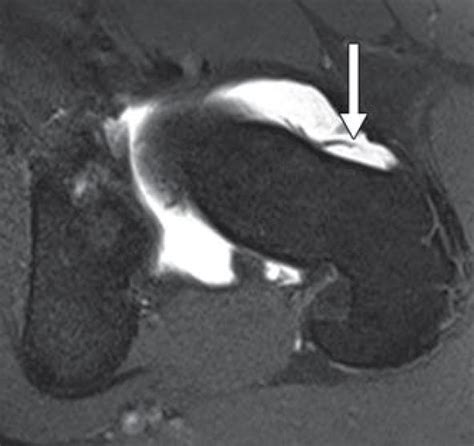 Hip Magnetic Resonance Imaging Recon Orthobullets