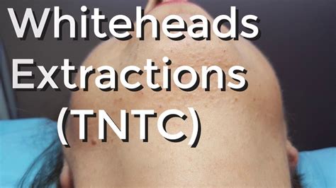 Whiteheads Extraction Tntc Session I Part 1 Youtube