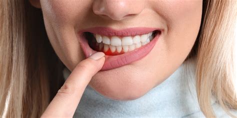 10 Causes Of Painful Swollen Gums Why Are My Gums Swollen Ph