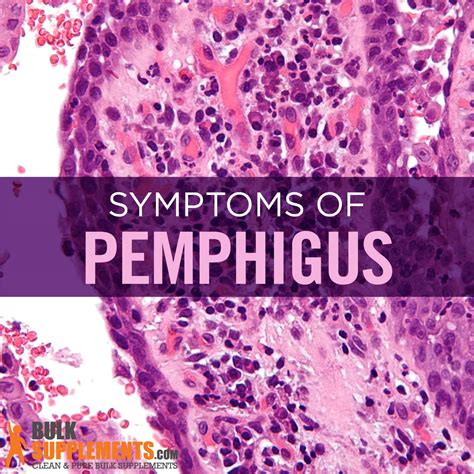 Pemphigus Symptoms Causes And Treatment By James Denlinger
