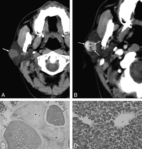Myoepithelioma Of The Parotid Gland Ct Imaging Findings American