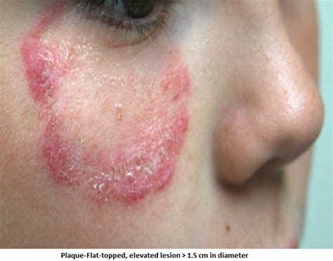 Std Rash On Face Pictures Oral Stds Pictures Types Symptoms Treatment