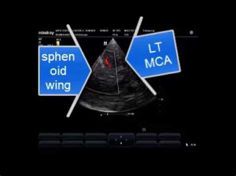 An Easy Way To Localize Middle Cerebral Artery By Trans Cranial Doppler