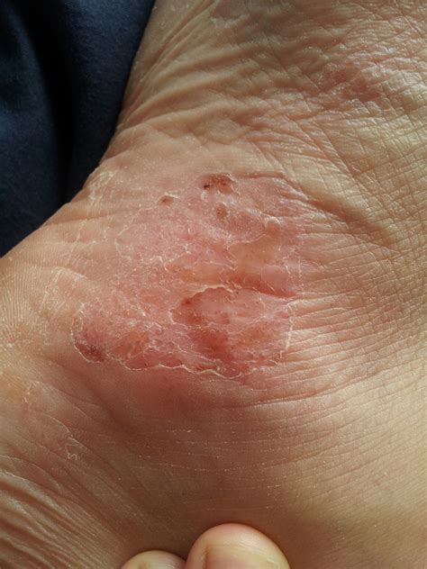 Pompholyx An Extreme Eczema Of The Hands Or Feet